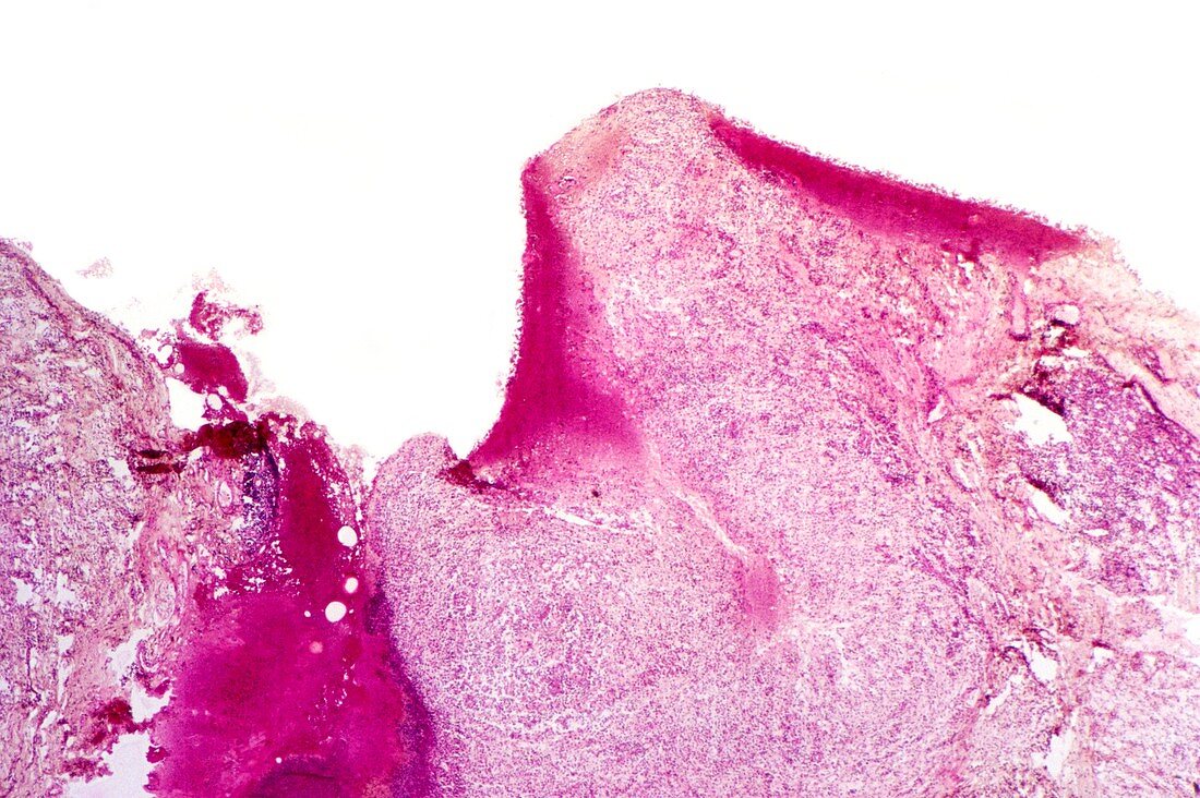 Fungal skin infection,light micrograph