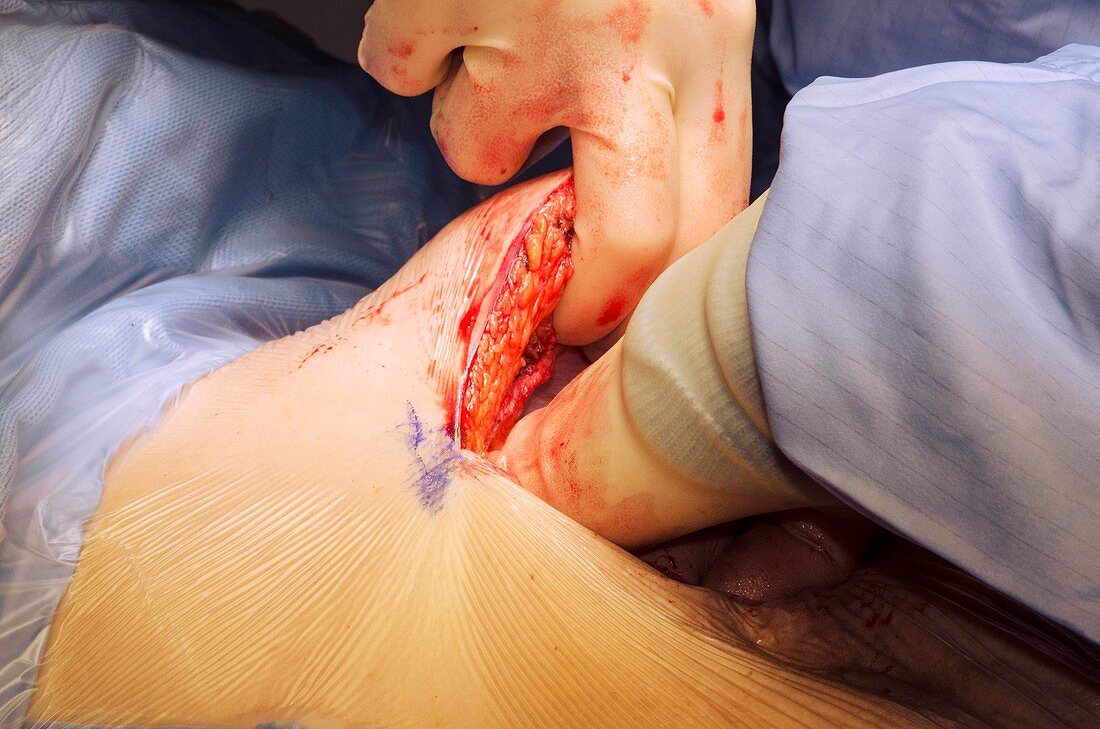 Pancreatectomy and splenectomy surgery