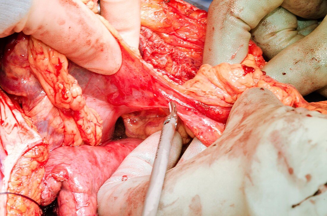 Pancreatectomy and splenectomy surgery