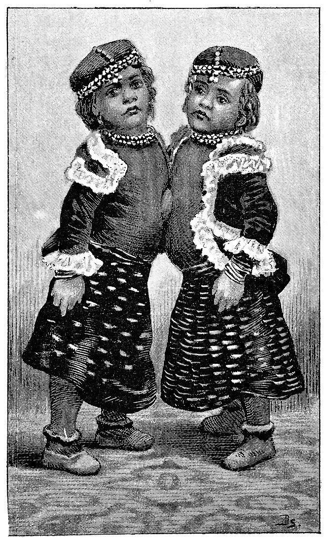 Conjoined twins,1893