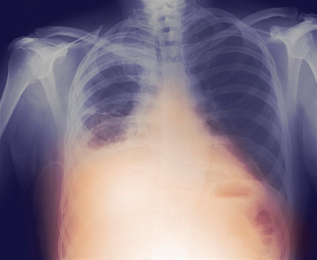 Drained pleural effusion,X-ray