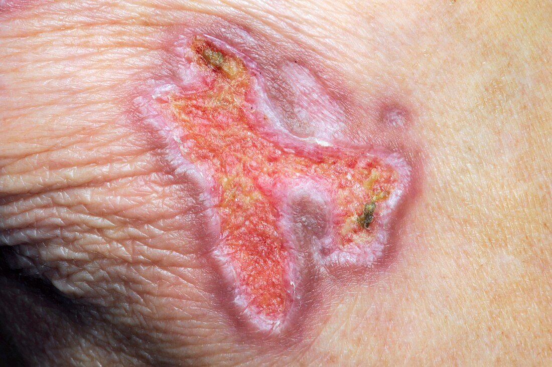 Skin lesion in dermatomyositis