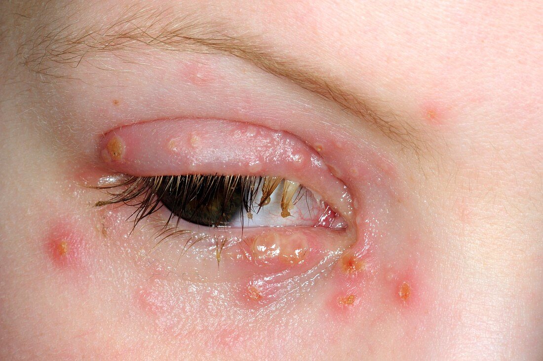 Herpes infection of the eyelid