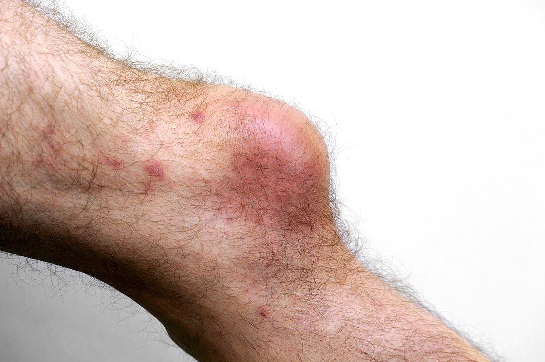 Bursitis of the knee