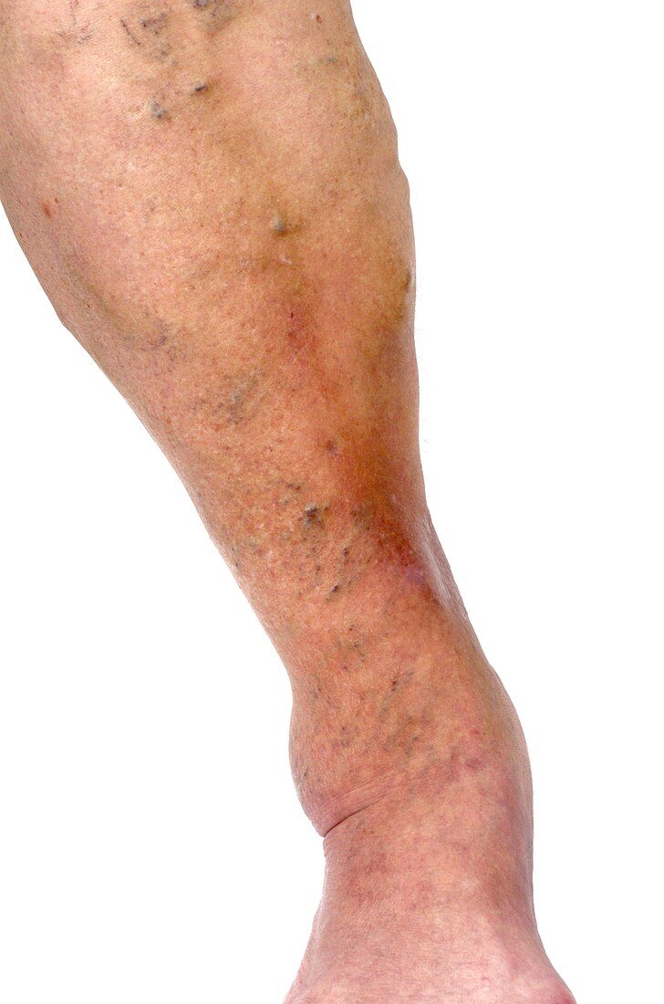 Lipodermatosclerosis of the leg