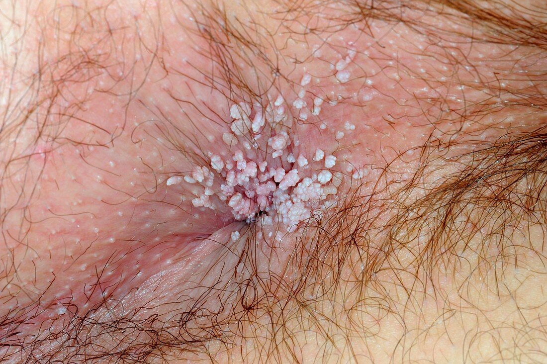 Genital warts around the anus