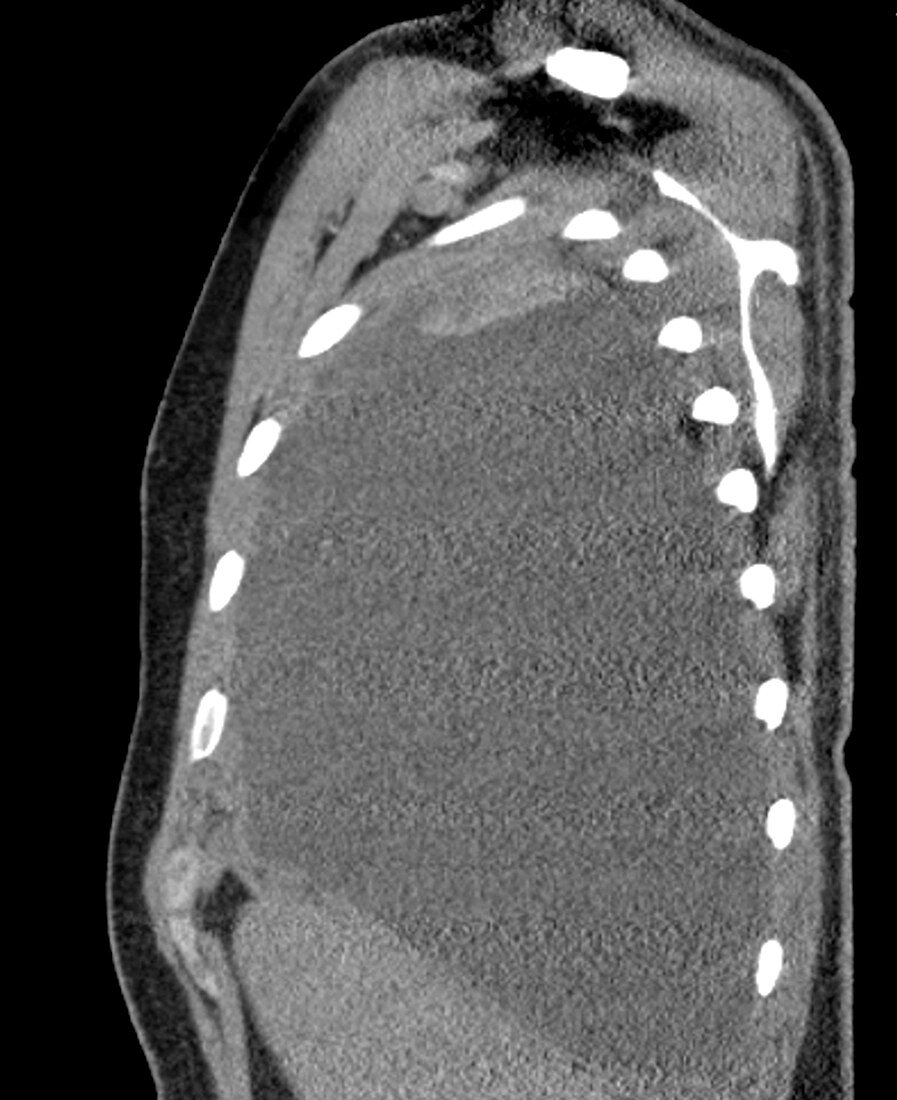 Pleural effusion in mesothelioma,CT scan