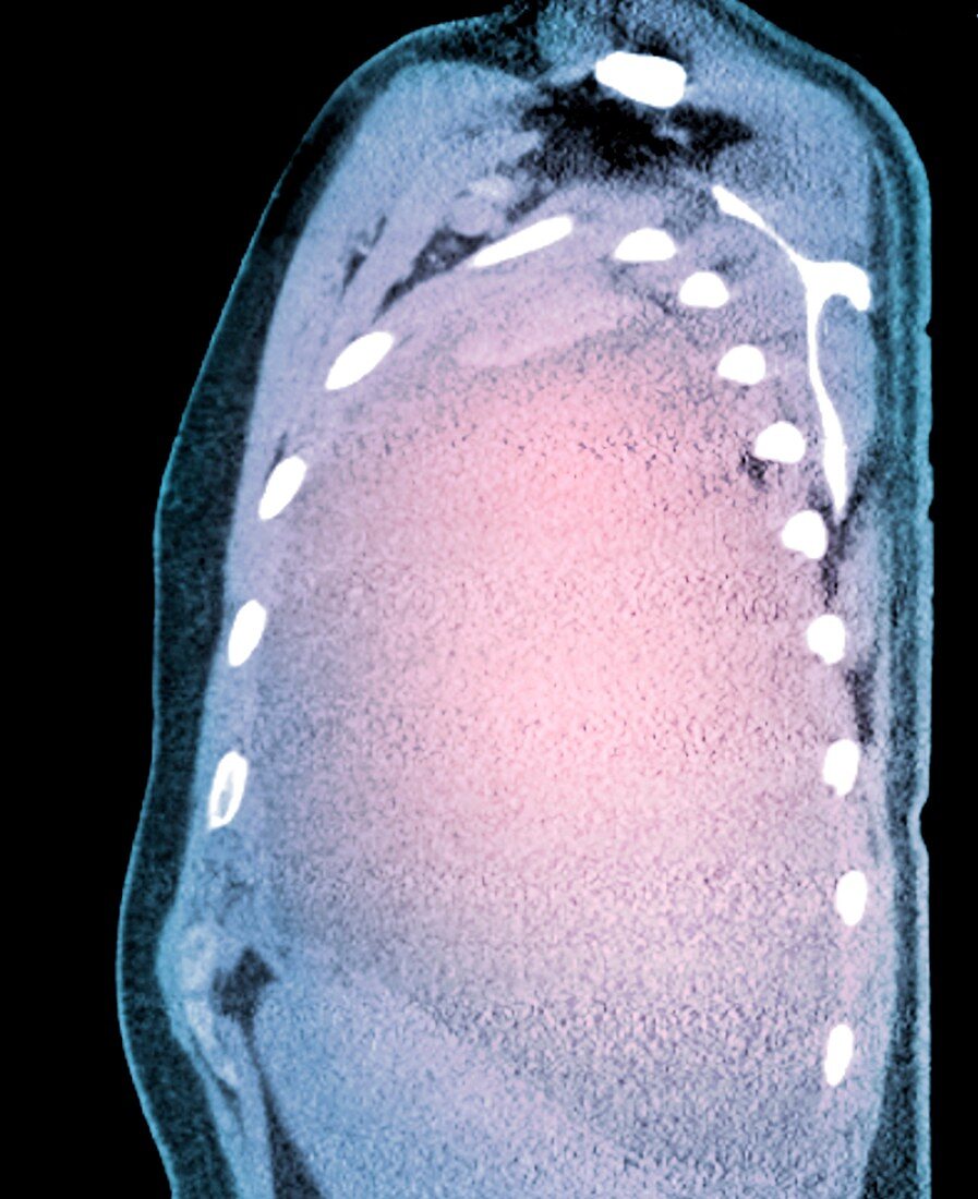 Pleural effusion in mesothelioma,CT scan