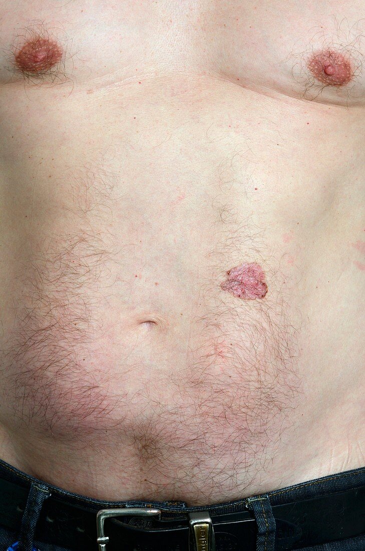 Basal cell skin cancer on the body