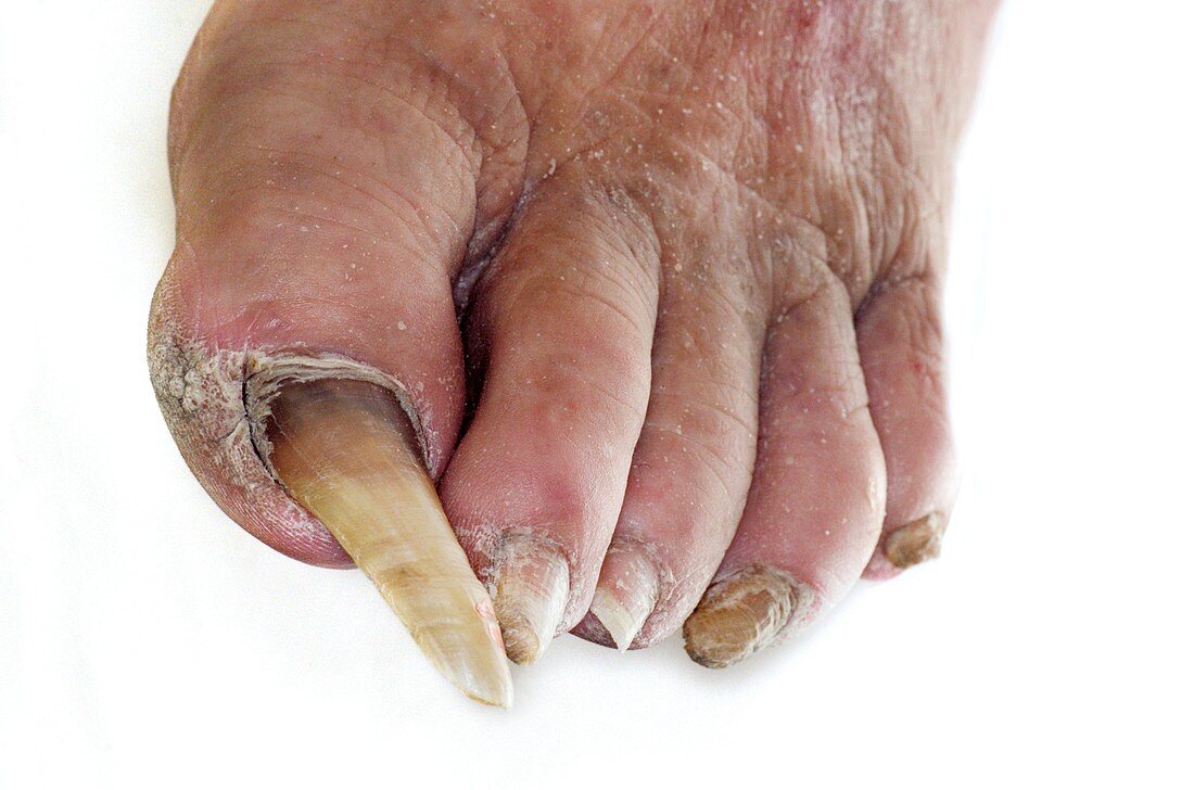 Overgrown toenail (hypertrophy)