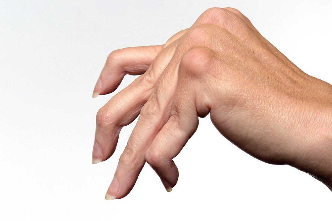 Rheumatoid arthritis of the fingers