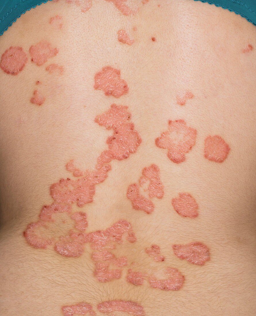 Psoriasis on the back before treatment