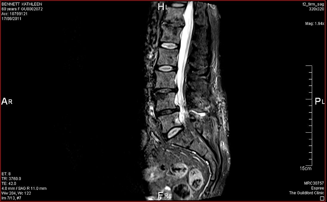 Prolapsed lumbar disc,MRI scan