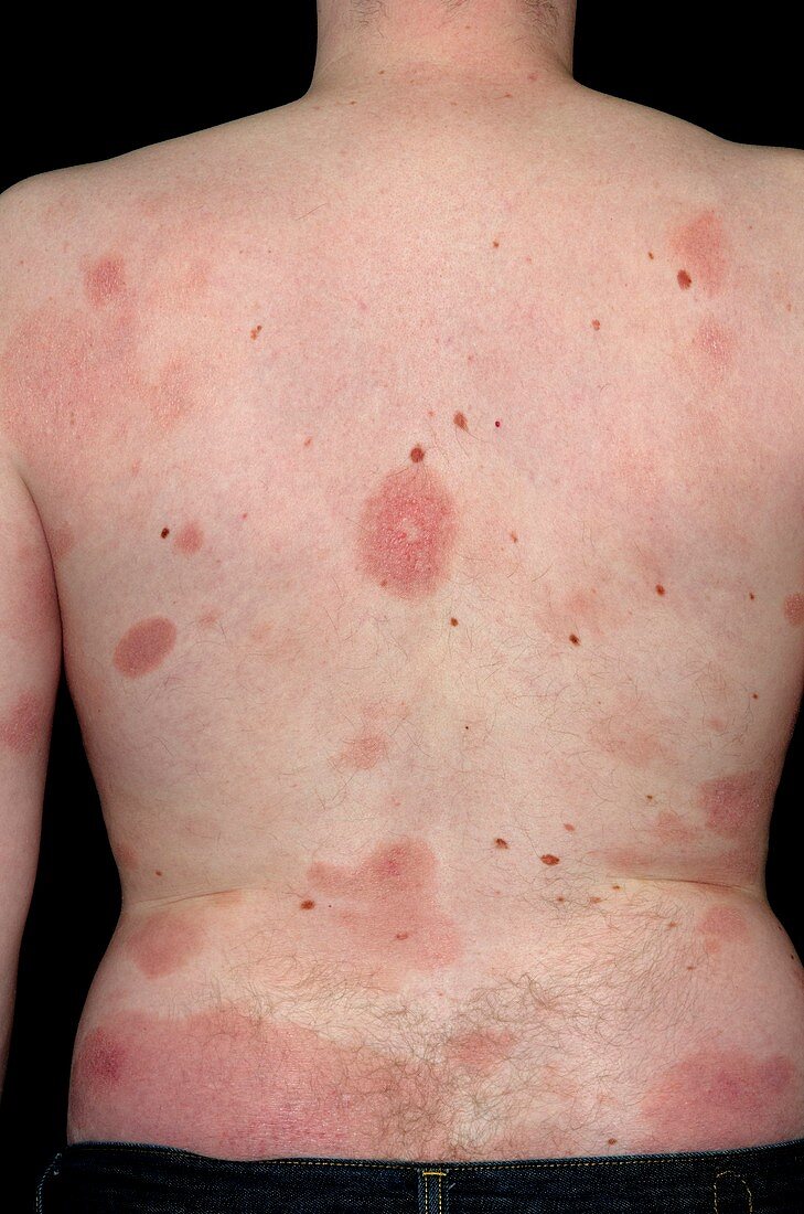 Skin in Mycosis fungoides