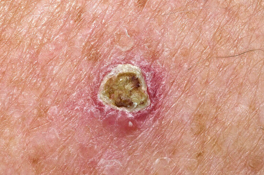 Basal cell skin cancer on the back