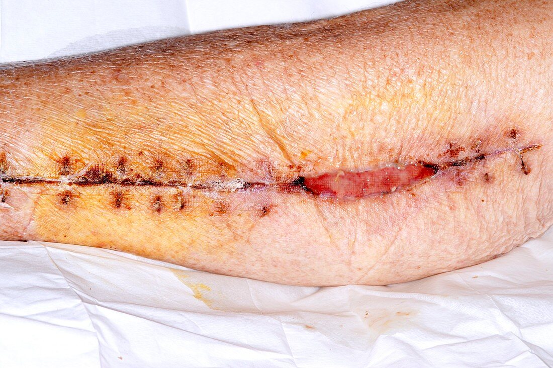 Calf wound healing after artery surgery