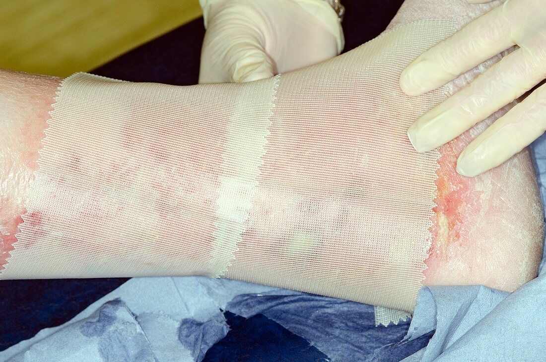 Treated infection of a calf injury