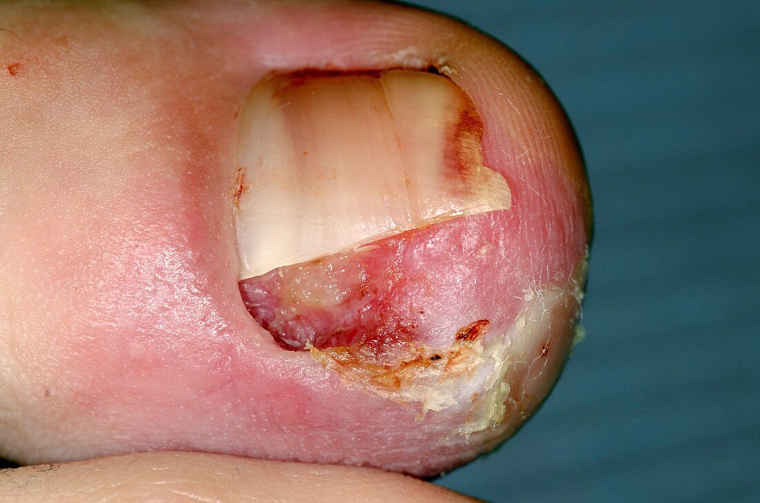 Ingrowing toenail after surgery