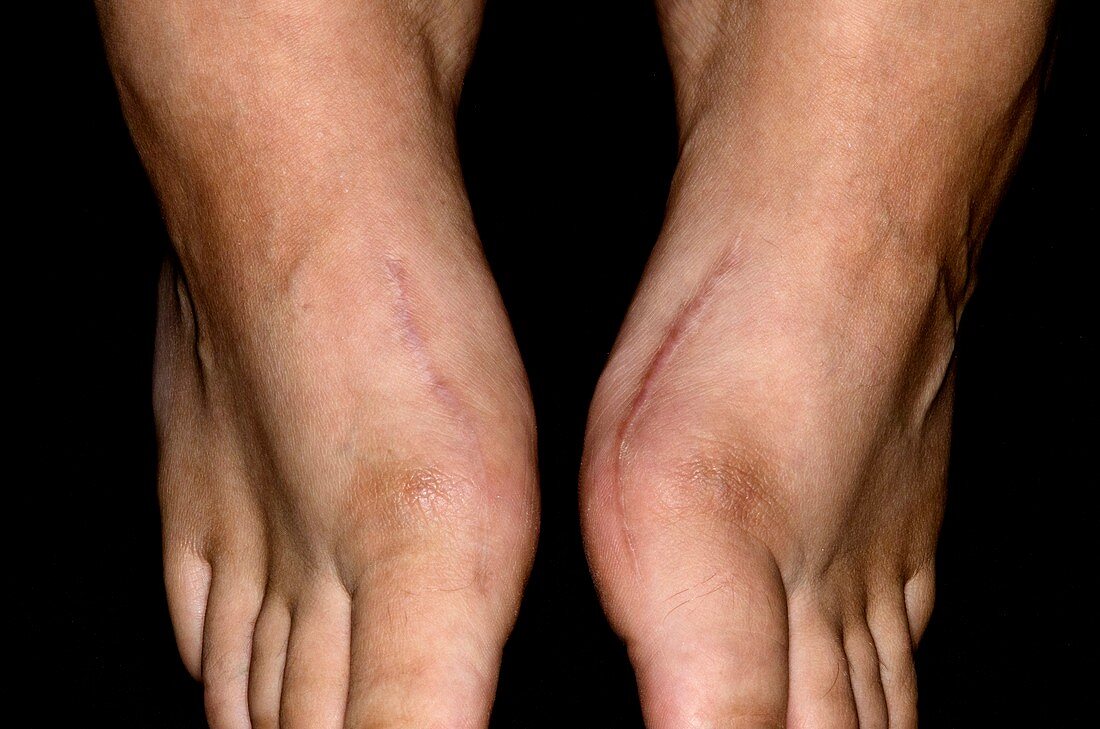 Scars from bunion surgery