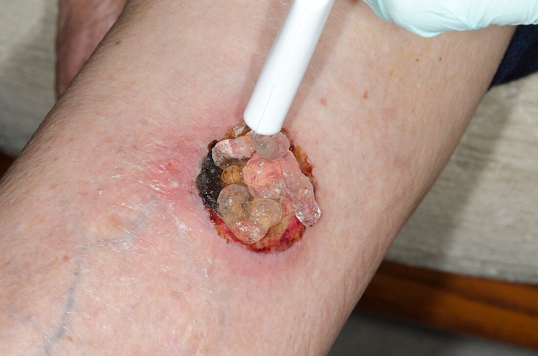 Wound after skin cancer removal