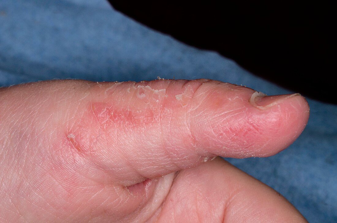 Eczema secondary to thumb sucking