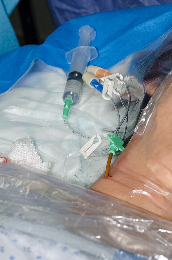 Central venous catheterisation