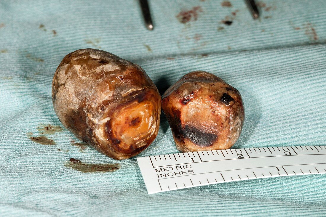 Excised gallstones