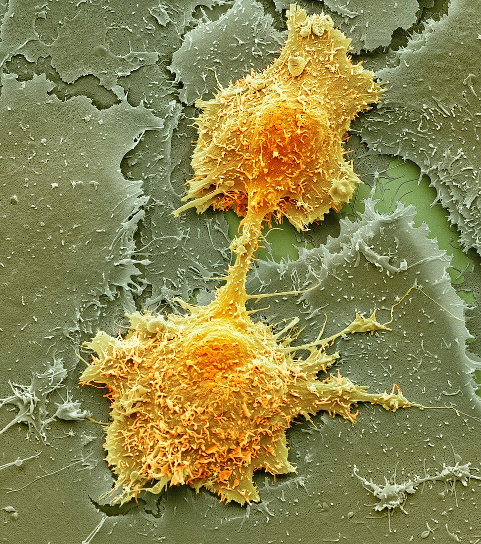 Mouth cancer cell dividing,SEM