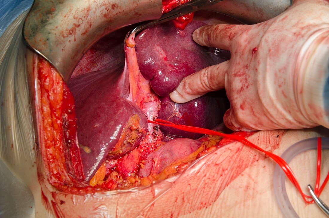 Liver surgery