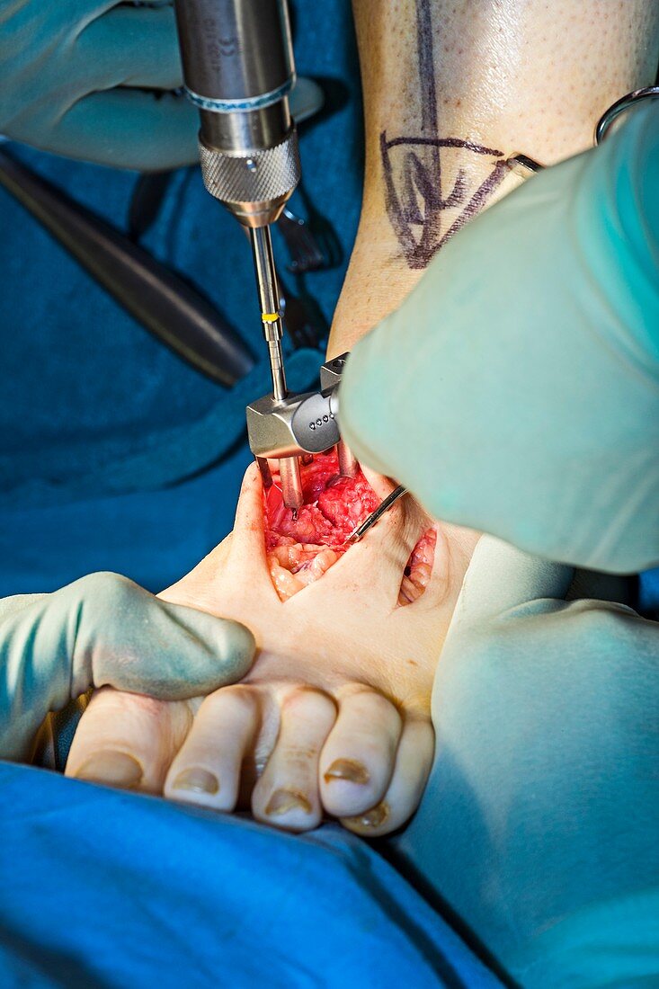 Cavus foot surgery,metatarsal pinning