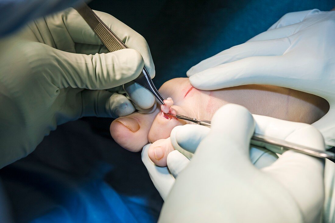 Toe joint replacement surgery