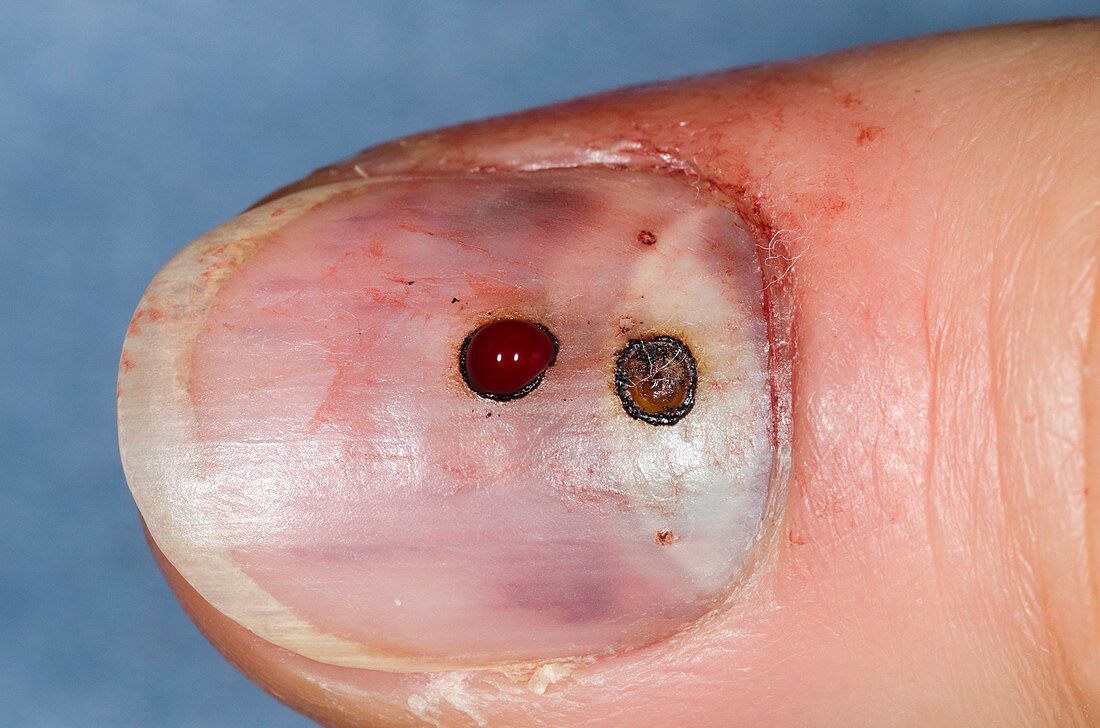 Treated bruise under fingernail