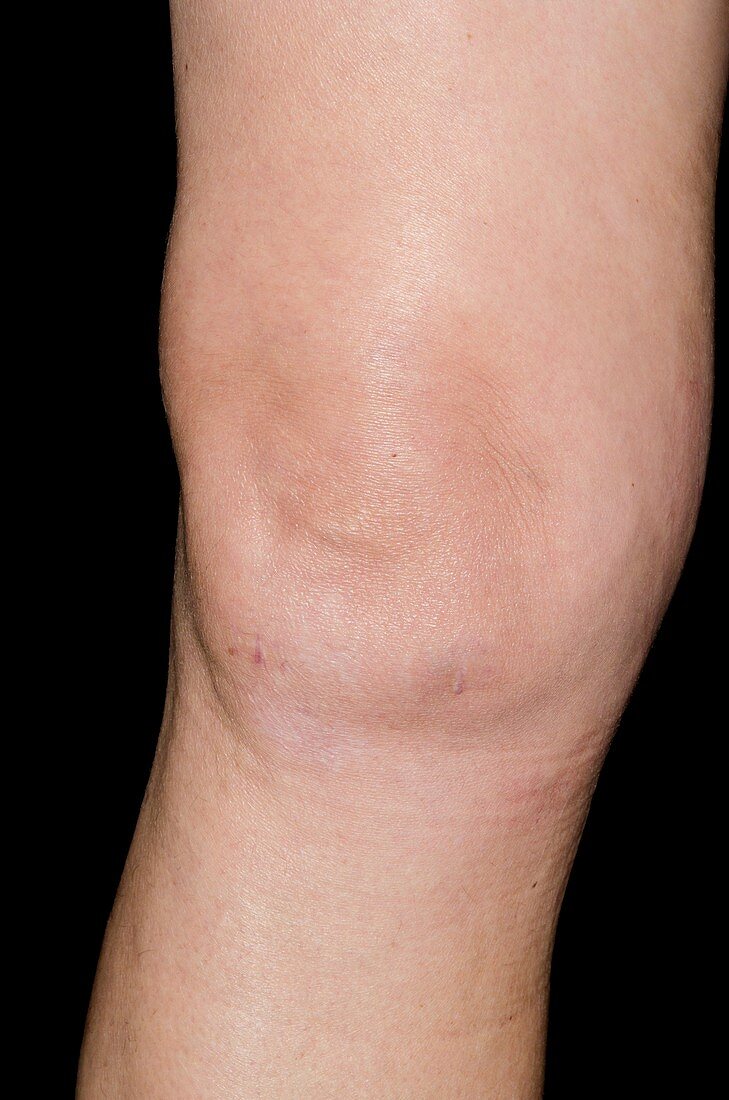 Effusion of the knee after surgery