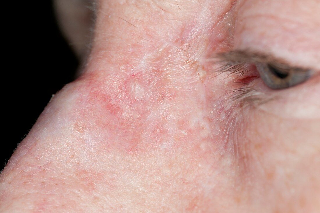 Excised skin cancer of the nose