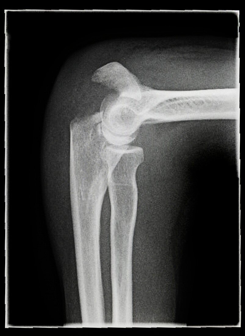Broken elbow,X-ray