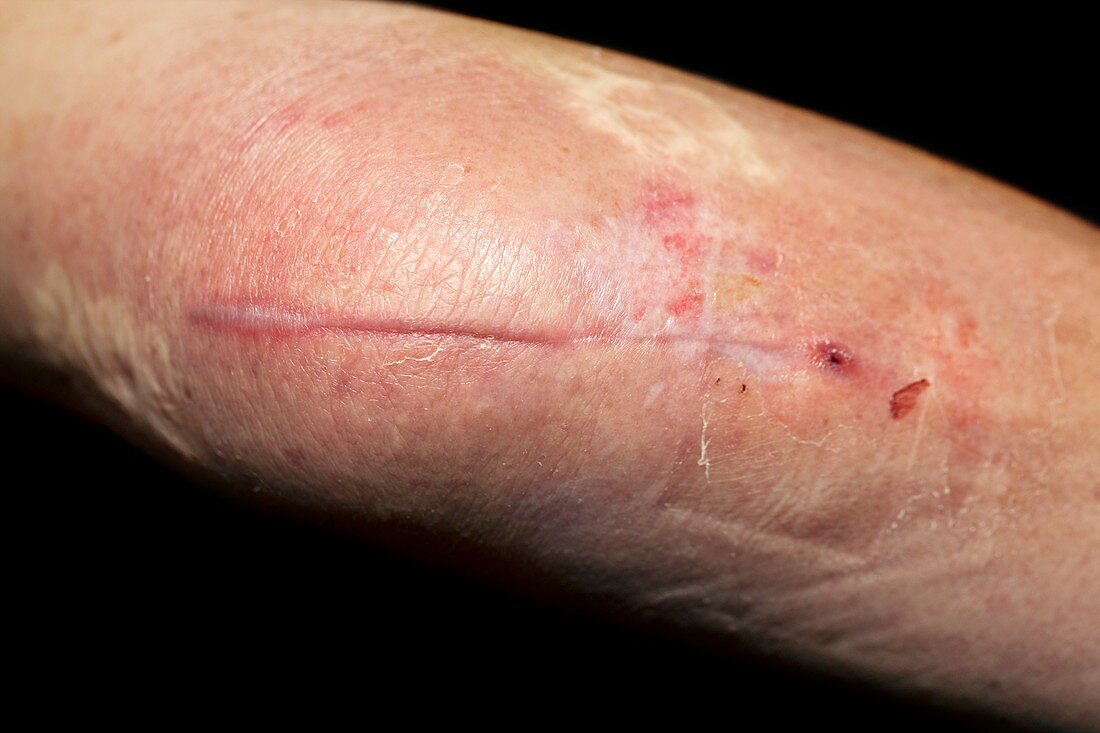 Scar after broken elbow repair