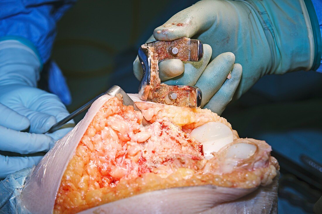 Knee replacement surgery,obese patient