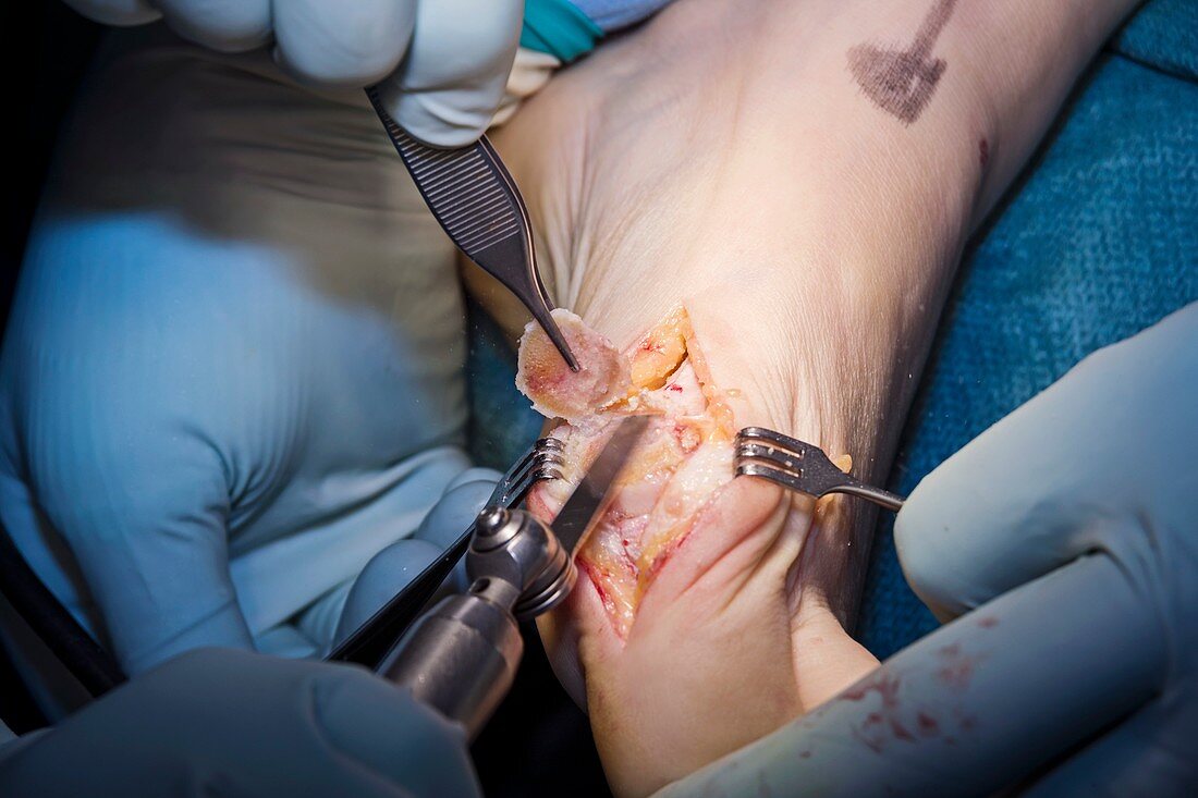 Bunion surgery