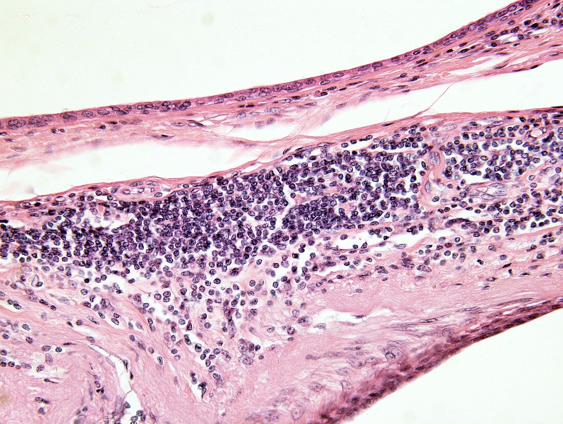 Oesophageal cancer,light micrograph