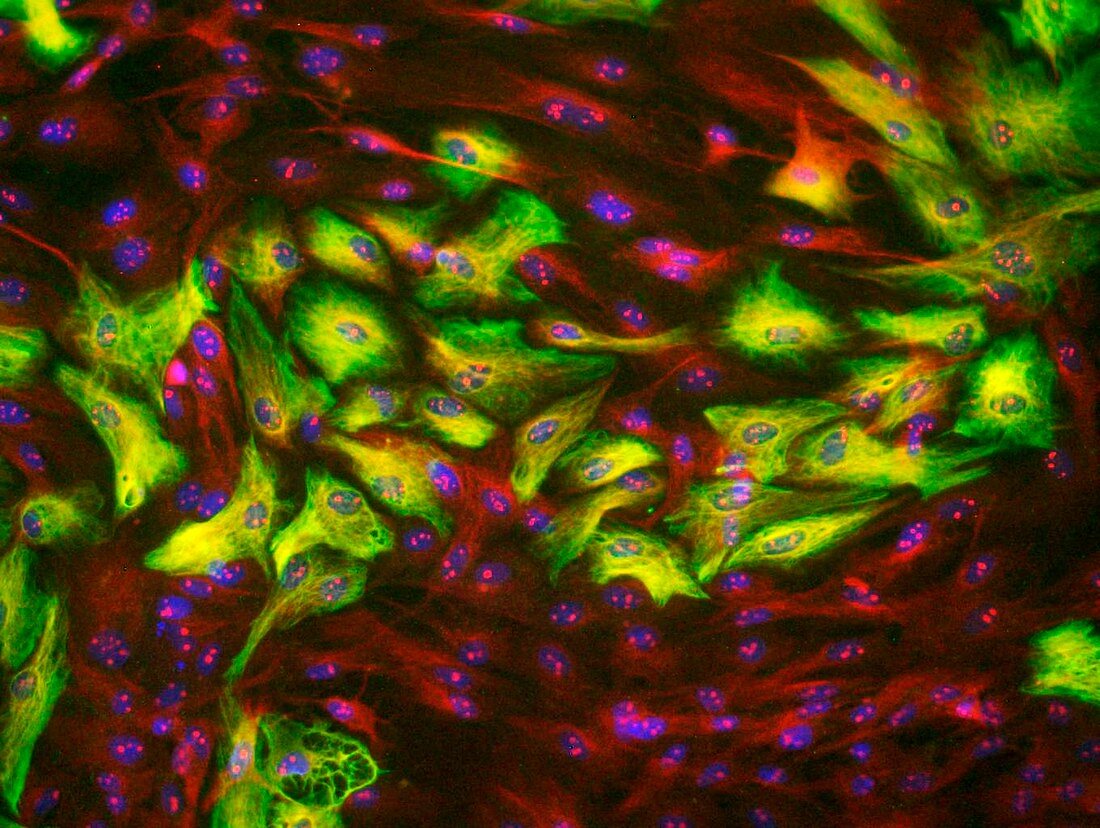 Astrocyte brain cells,light micrograph