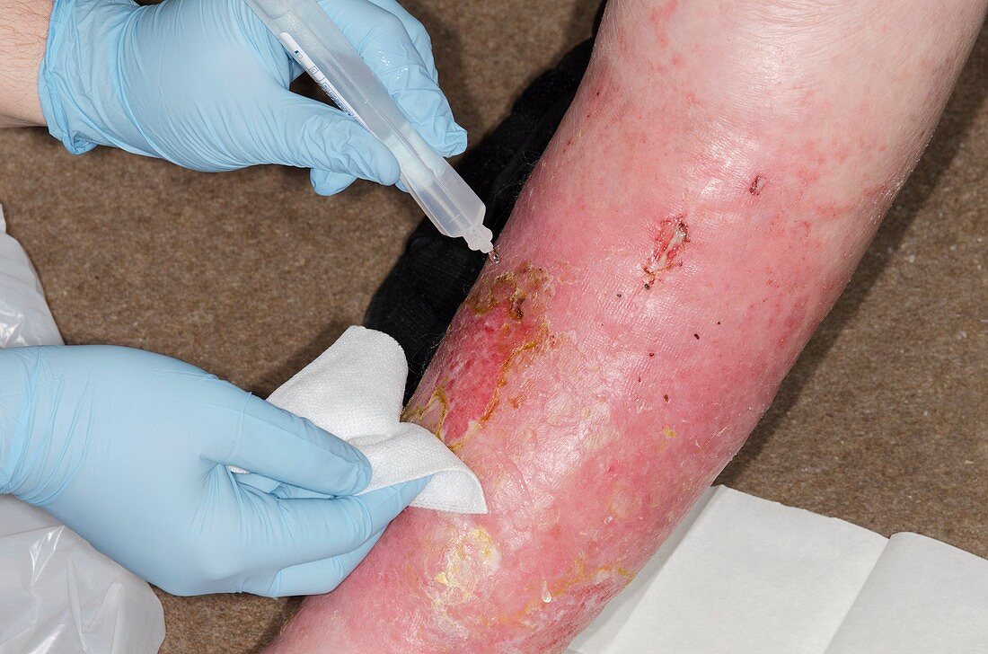 Infected leg ulcer being dressed