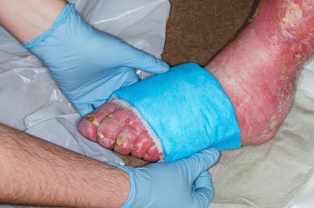Infected leg ulcer being dressed
