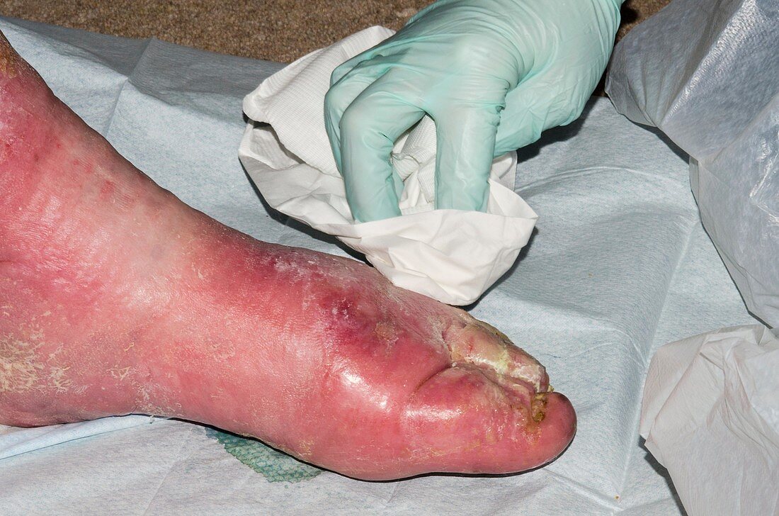 Infected leg ulcer being dressed