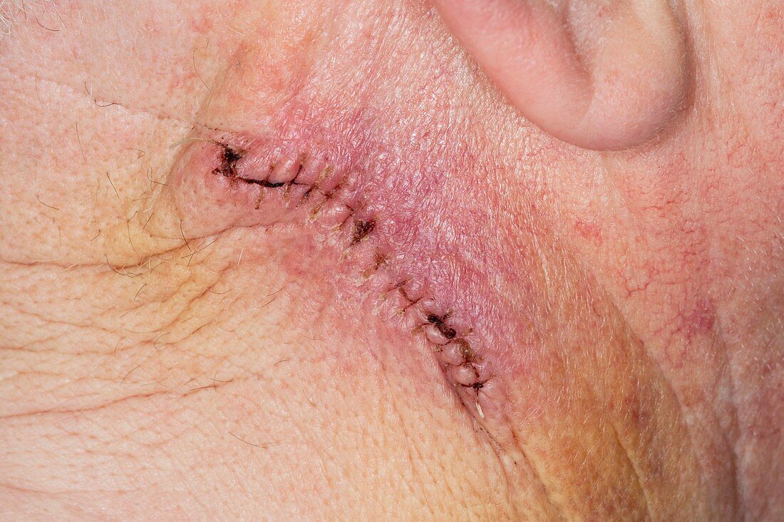 Infected surgical wound