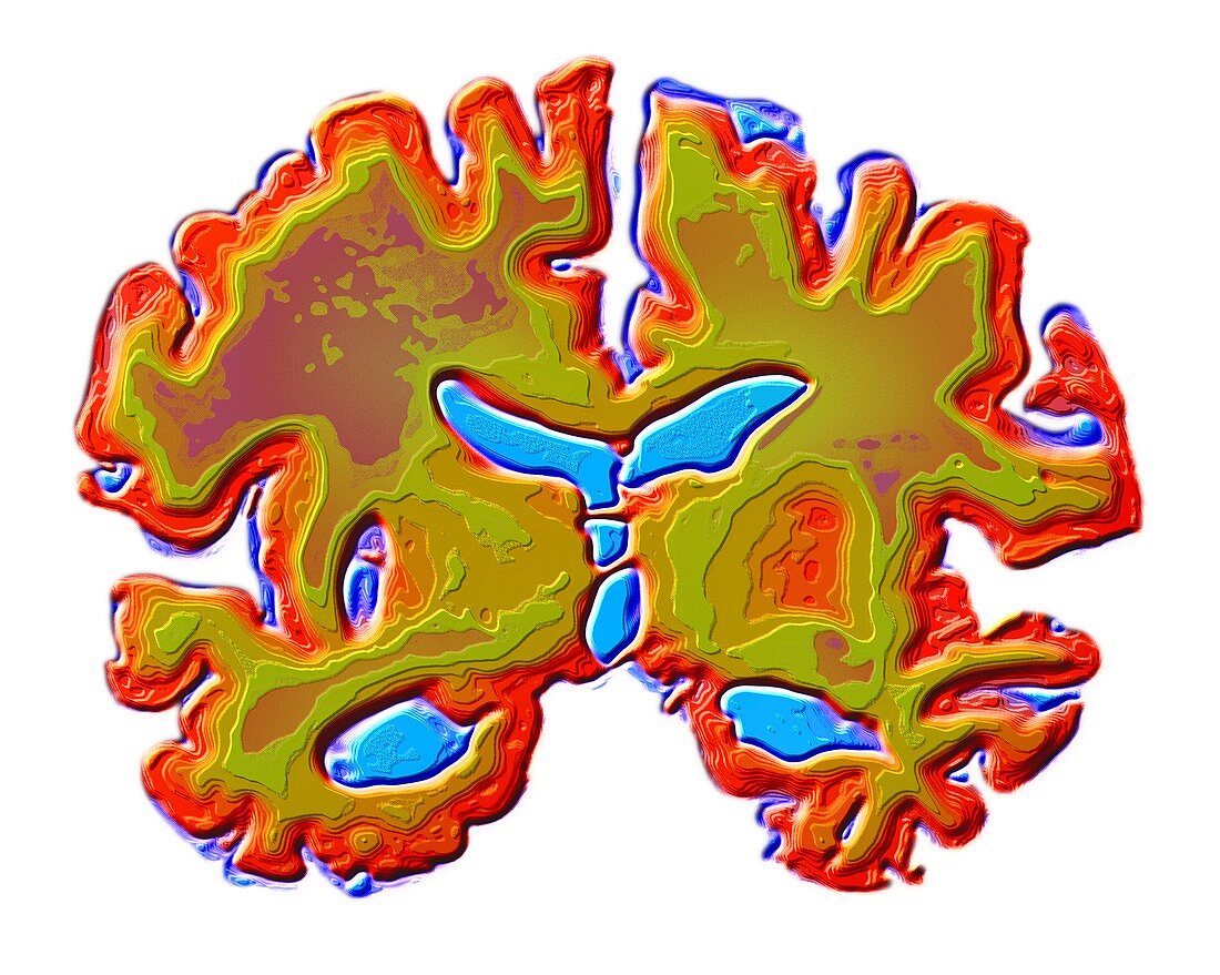 Altheimer's brain