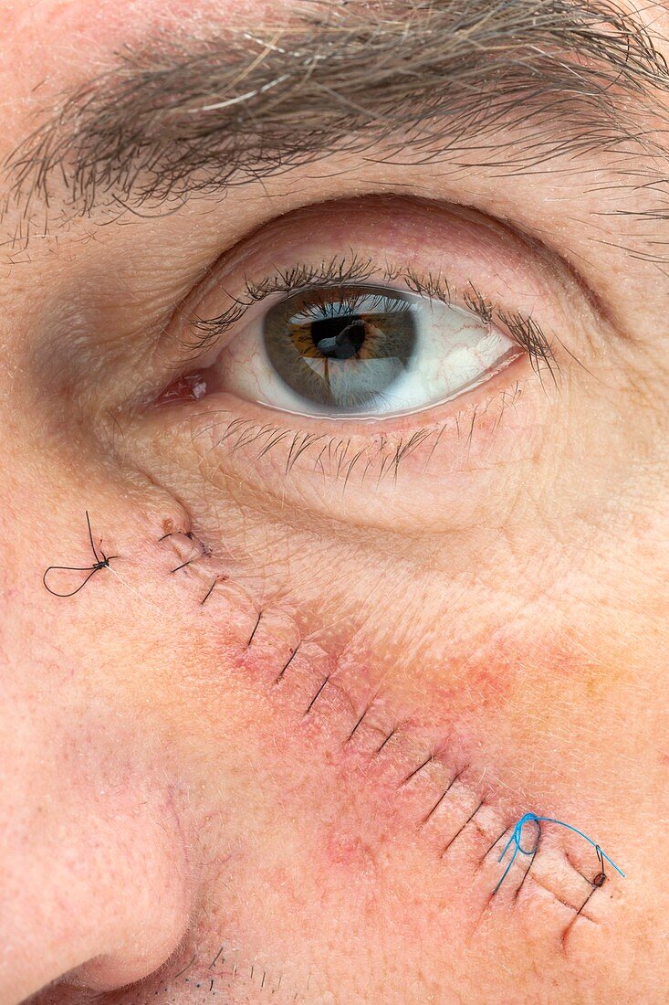 Basal cell carcinoma treatment