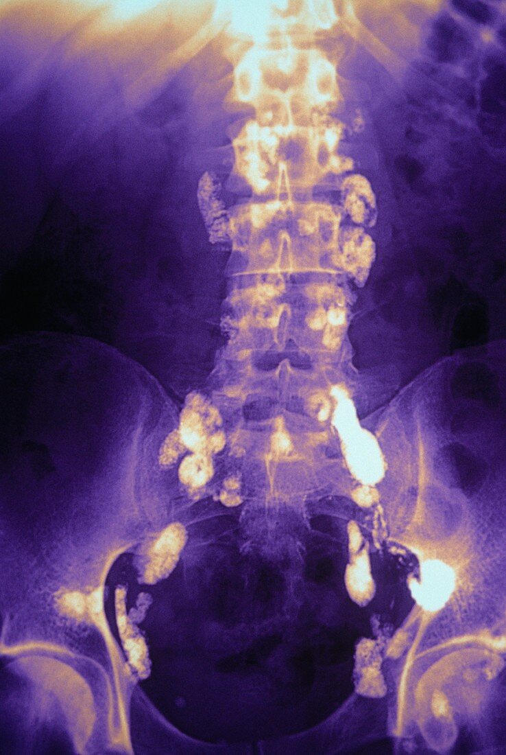 Hodgkin's disease,X-ray tumour