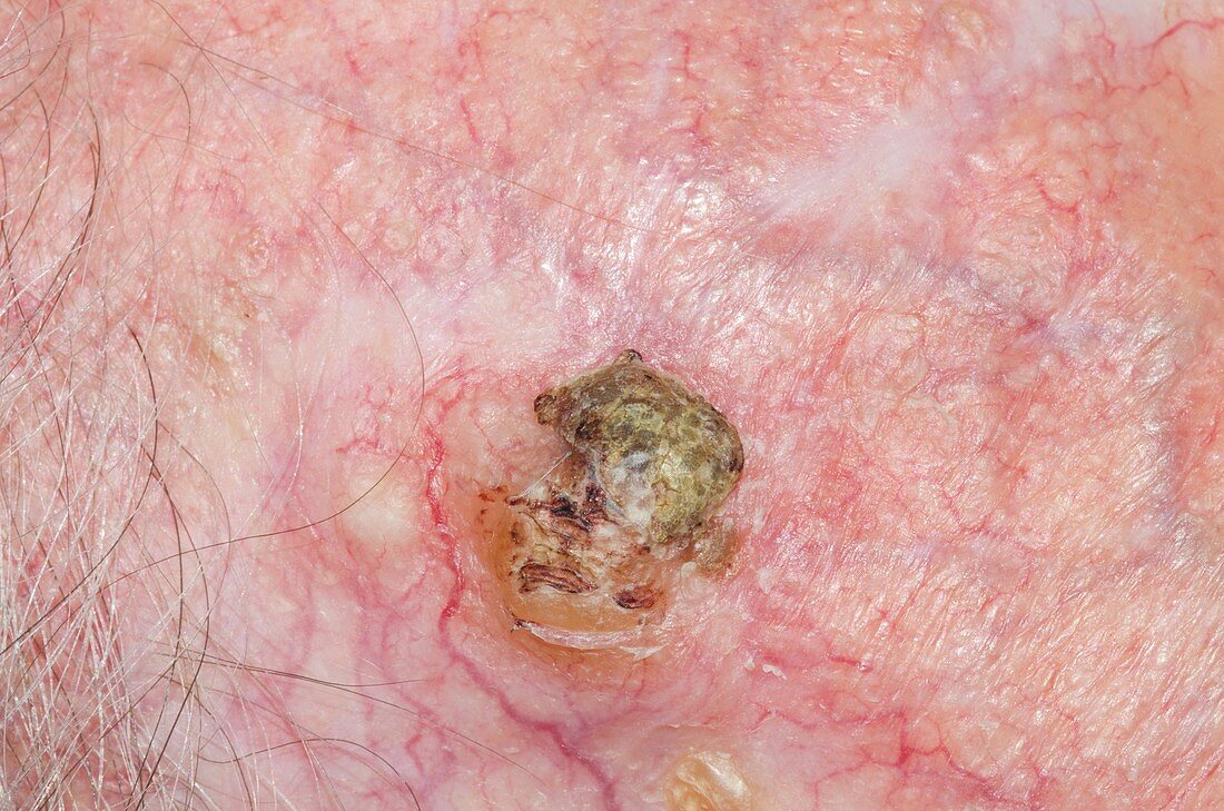 Squamous skin cancer on the scalp