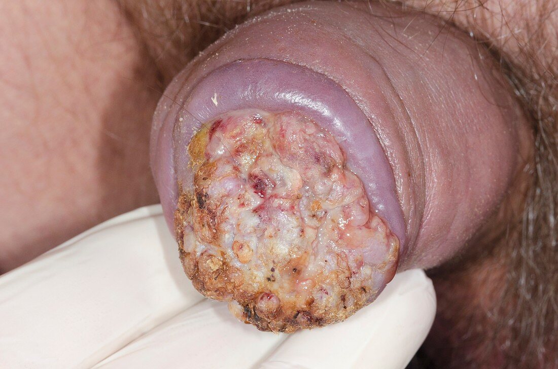 Fungating penile skin cancer