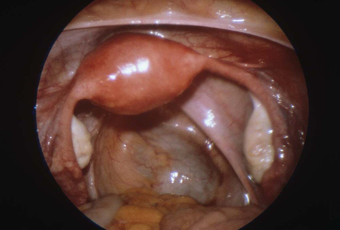 Healthy uterus,endoscope view – Bild kaufen – 11642344 ❘ Science Photo  Library